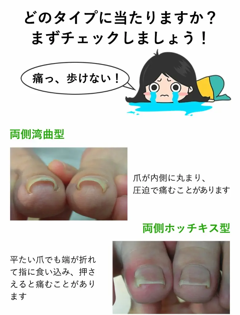巻き爪リフト