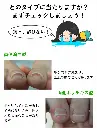 巻き爪リフト