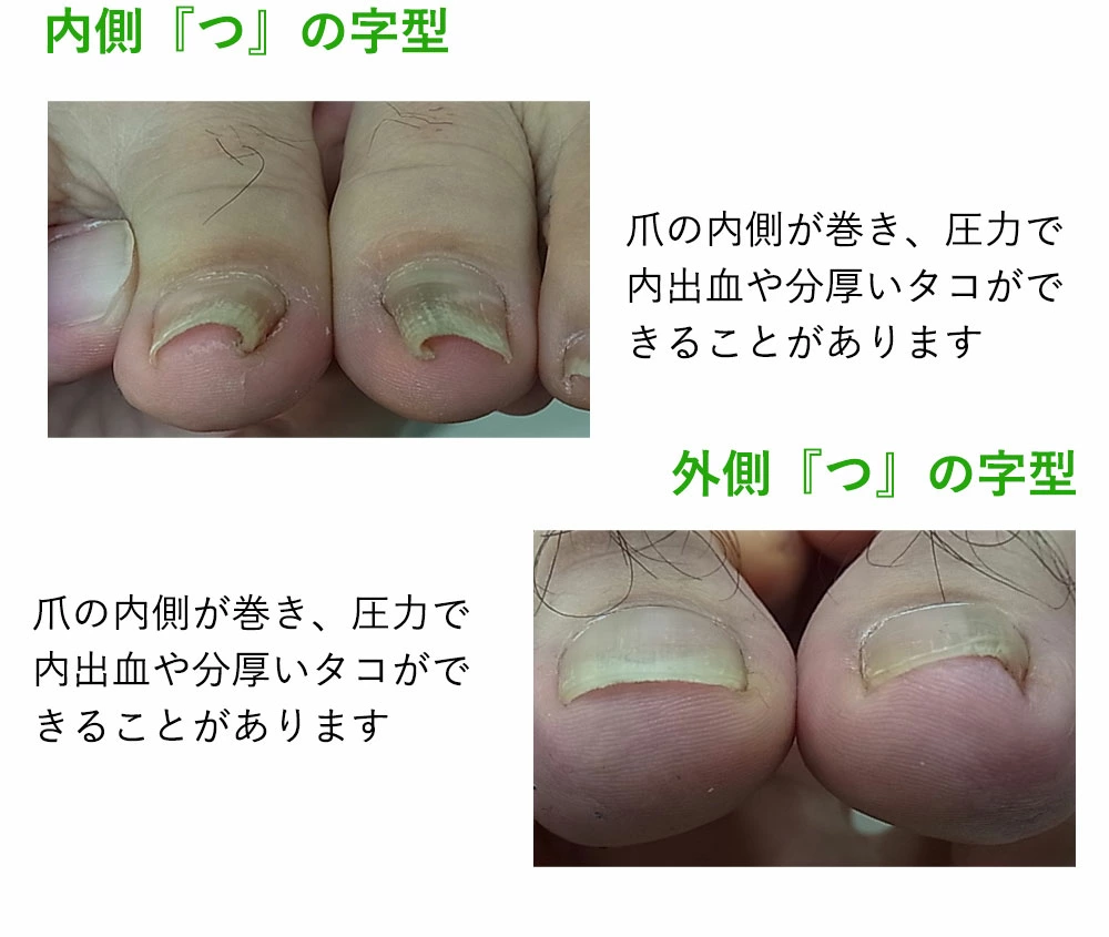 巻き爪リフト
