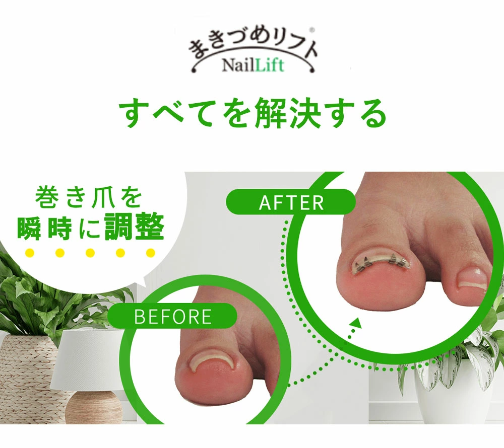 巻き爪リフト